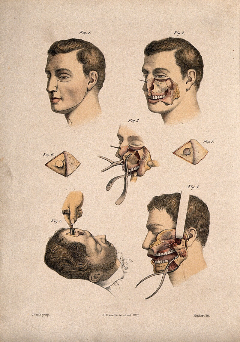Sinuses
